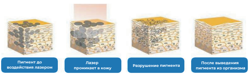 Как удаляют тату Как удаляют тату