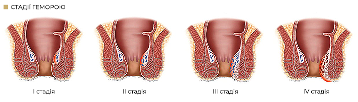 стадии геморроя укр.png стадии геморроя укр.png